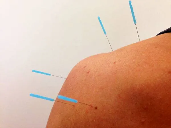 DJMwJz5-2 how is dry needling different from acupuncture