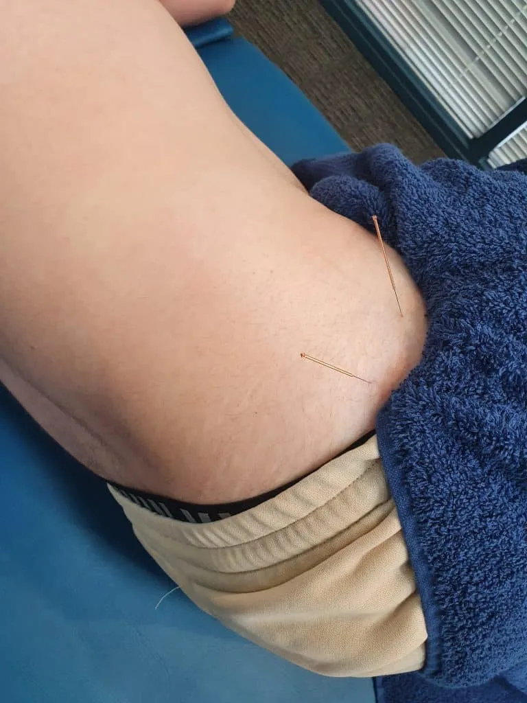 U918Sh8-2 can dry needling help sciatica