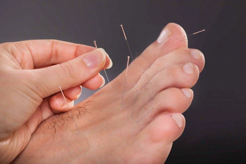 YAHL3sk-2 can dry needling help tendonitis