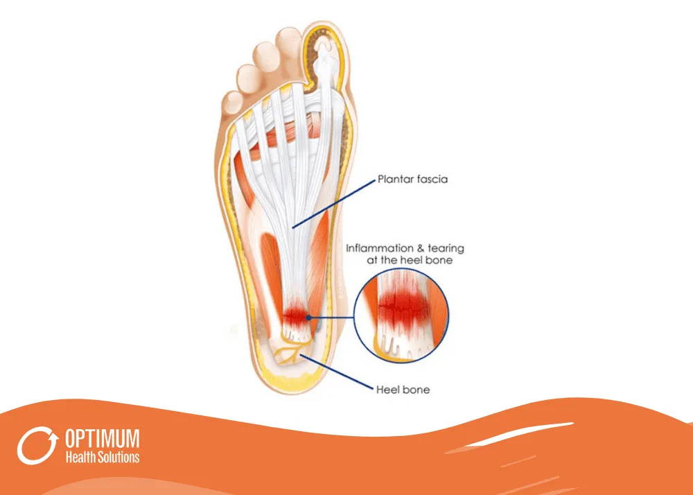 bVca4F6-2 can dry needling help plantar fasciitis