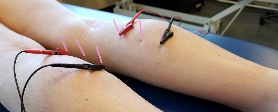 what is dry needling good for
