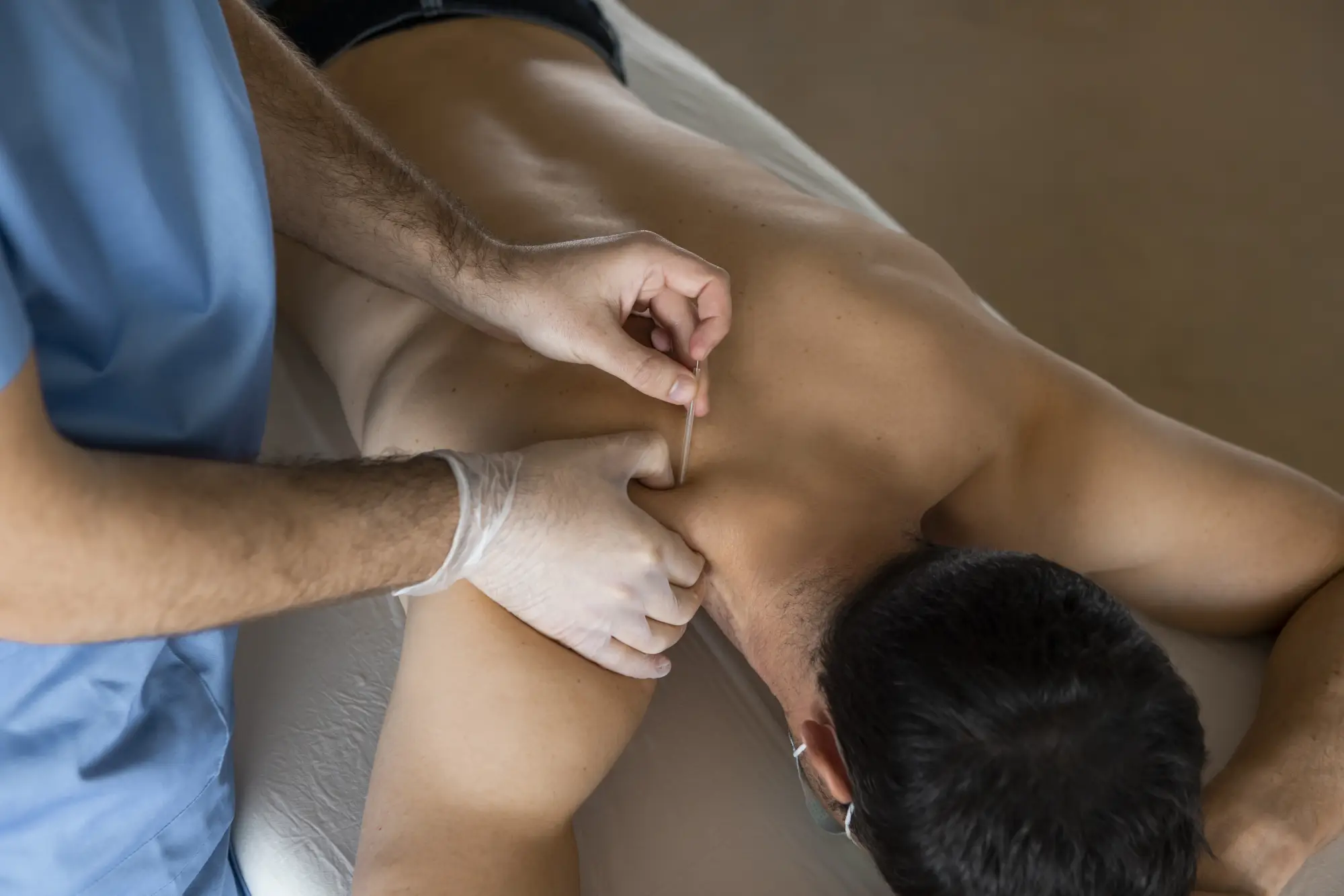 Dry Needling for Sciatica