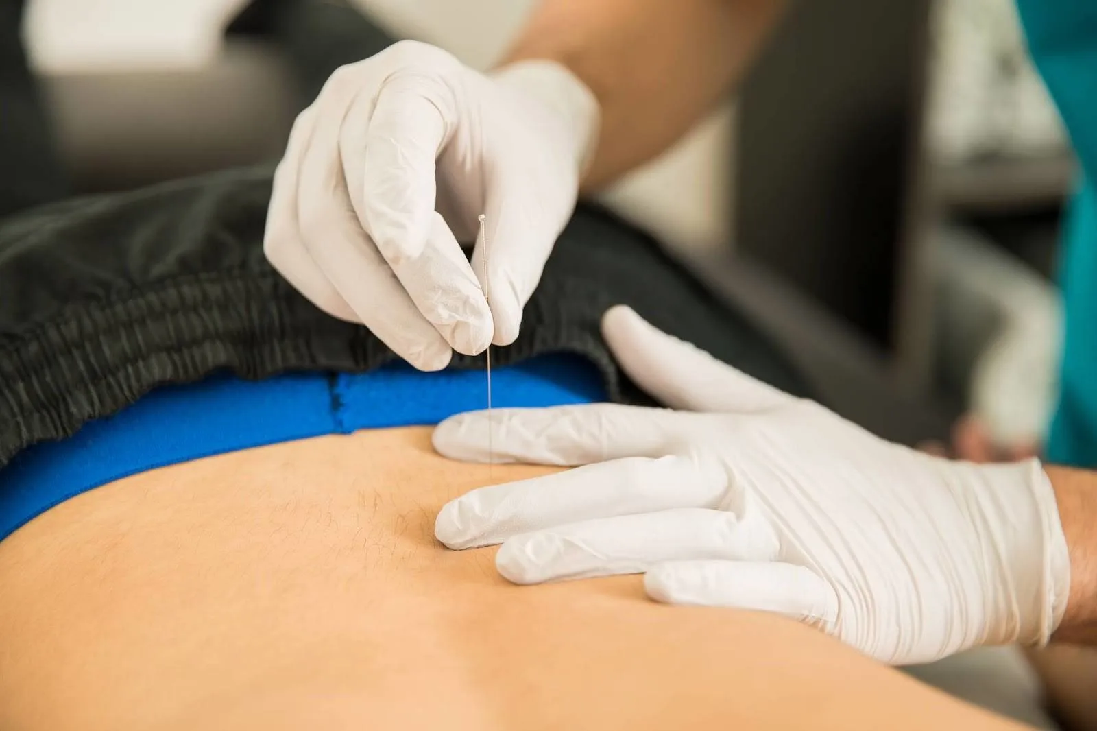 Dry Needling the Hip Flexor