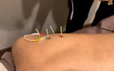 Dry Needling vs Massage: Which One Is Right for You?