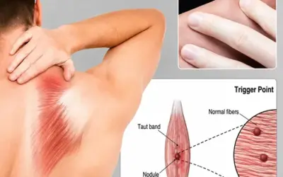 Will Dry Needling Help Lower Back Pain?