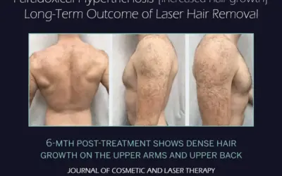 Are there side effects to laser therapy?