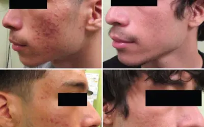 How long does it take for laser therapy to work?