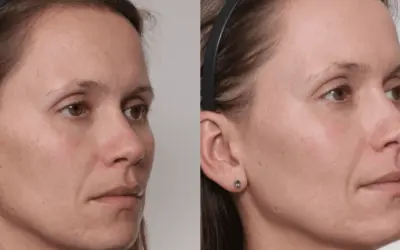 What happens after laser therapy?