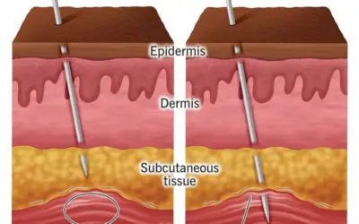 What conditions are treated with dry needling?
