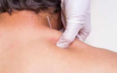 Which is better dry needling or acupuncture?