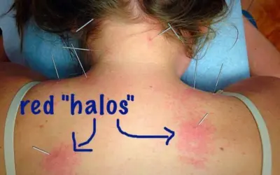Who should not get dry needling?