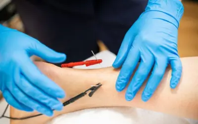 Can you hit a nerve while dry needling?