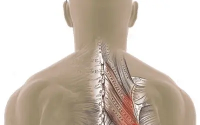Dry needling vs trigger points