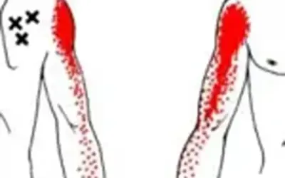 Will dry needling help frozen shoulder