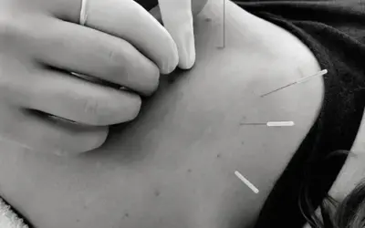 How long does it take to see results from dry needling?