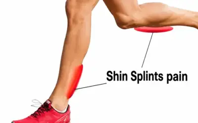 Will dry needling help shin splints