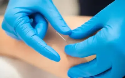 Will dry needling help tennis elbow