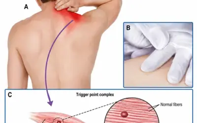 Will dry needling help sciatica